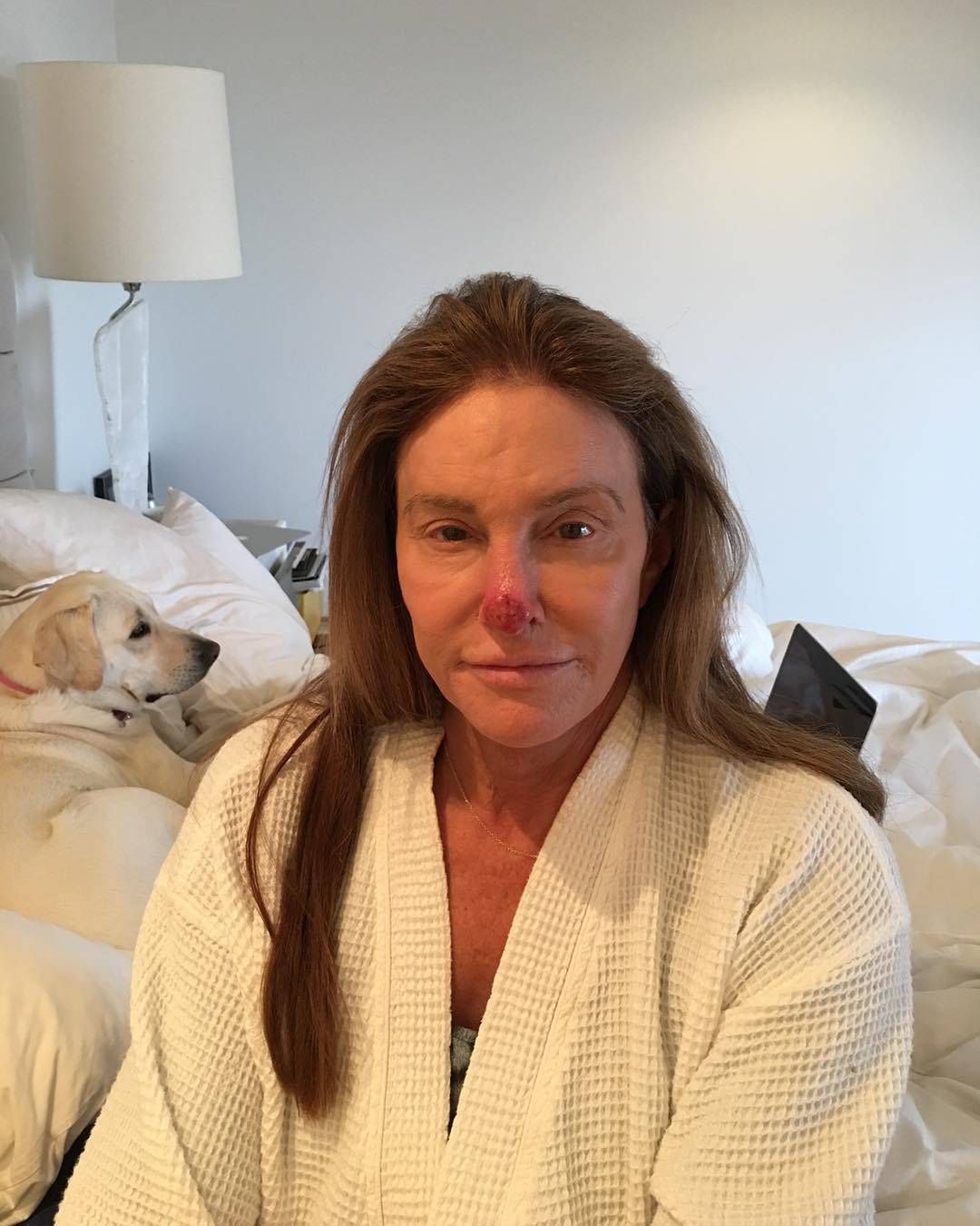 Caitlyn Jenner z wielką raną na nosie