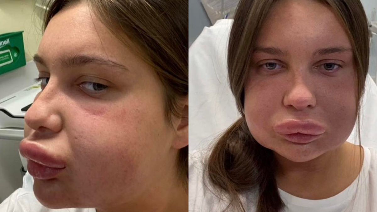 Wypełniacz ust wywołał silną reakcję alergiczną