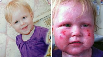 Po szczepieniu doznała rzadkiej reakcji alergicznej. Jej matka ostrzega!