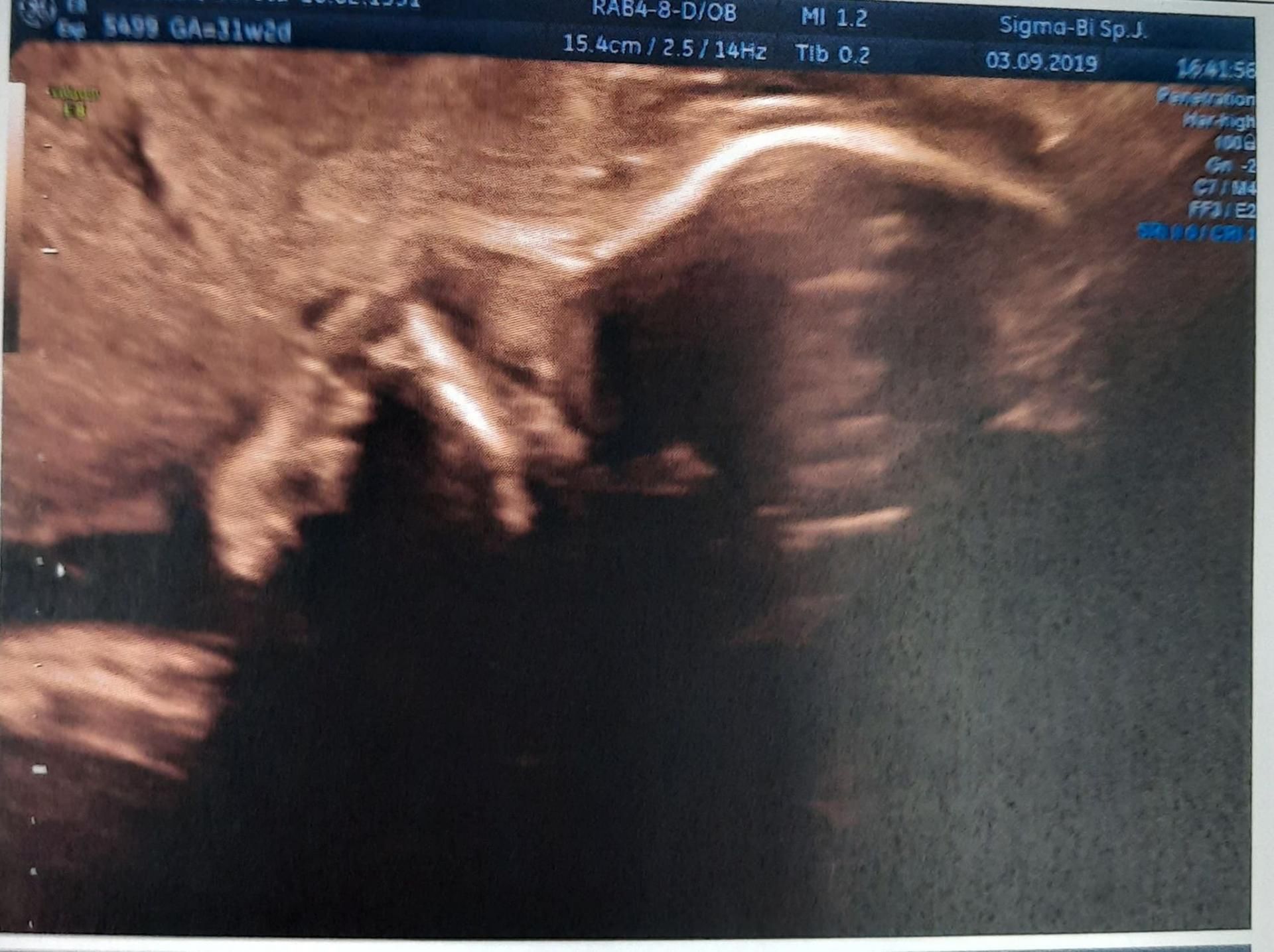 Kość nosowa nie występuje u 80 proc. płodów z zespołem Downa i u 1 proc. płodów bez wady