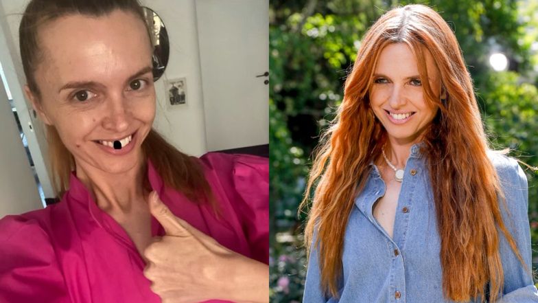 Katarzyna Burzyńska "straciła zęba" na wizji