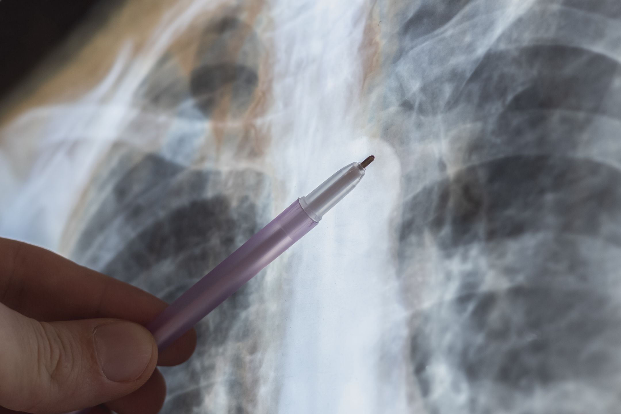 X-ray scan of Human bones disease. Spine cancer. Doctor learn diagnosis.
VADYM 
anatomy, back, backbone, body, bone, cancer, carcinoma, care, clinical, ct, diagnosis, disease, doctor, education, examination, hospital, human, illness, inflammation, injury, learning, medical, medicine, metastasis, mri, orthopedic, osteoarthritis, osteoporosis, pain, radiography, radiology, scan, skeletal, skeleton, spinal, spine, surgery, trauma, treatment, tumor, vertebra, vertebral, x-ray, mri, examination, learning, doctor, spine, bone, cancer, skeletal, metastasis, ct, carcinoma, x-ray, treatment, vertebral, tumor, education, osteoarthritis, vertebra, clinical, hospital, radiography, osteoporosis, surgery, disease, pain, human, backbone, anatomy, diagnosis, injury, skeleton, radiology, medical, medicine, illness, care, trauma, body, spinal, inflammation, back, scan, orthopedic