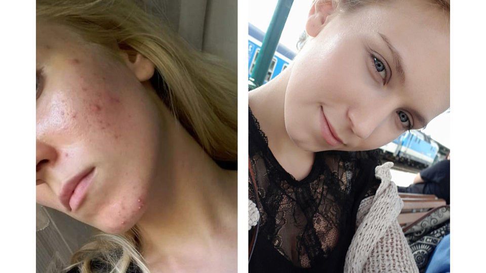 Całe życie walczyła z trądzikiem. Pokazała zdjęcia przed i po kuracji