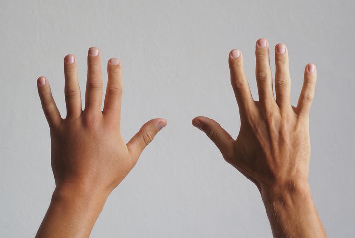 Obrzęk dłoni może być wynikiem urazu, zapalenia tkanek lub stawów dłoni.