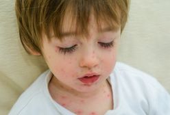Myślała, że syn ma alergię. Szybka reakcja uratowała jego zdrowie