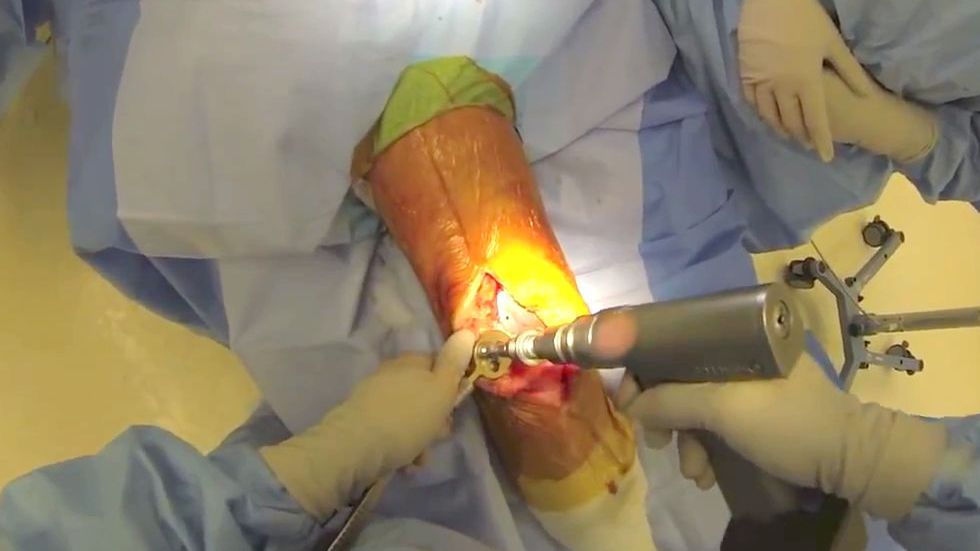 GoPro i medycyna, czyli wymiana kolana z bardzo bliska. Nie dla wrażliwych! 1