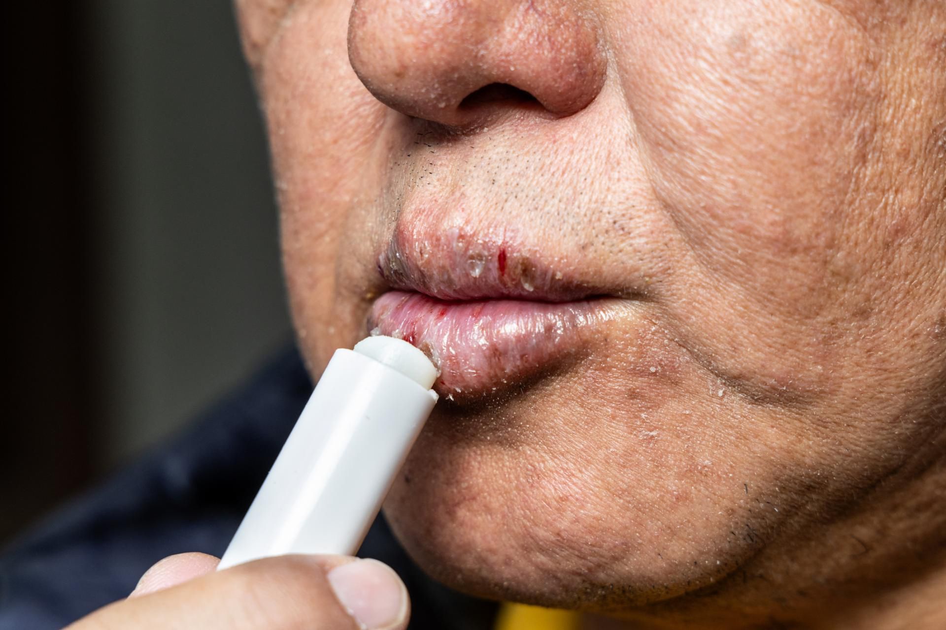 Suche, spierzchnięte usta mogą być oznaką poważnych problemów zdrowotnych