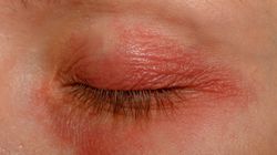 Utrata wzroku po terapii na otyłość? Ekspertka uspokaja 