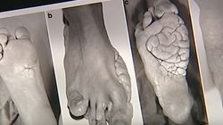 Zespół Proteusza - przyczyny, objawy, diagnostyka i leczenie