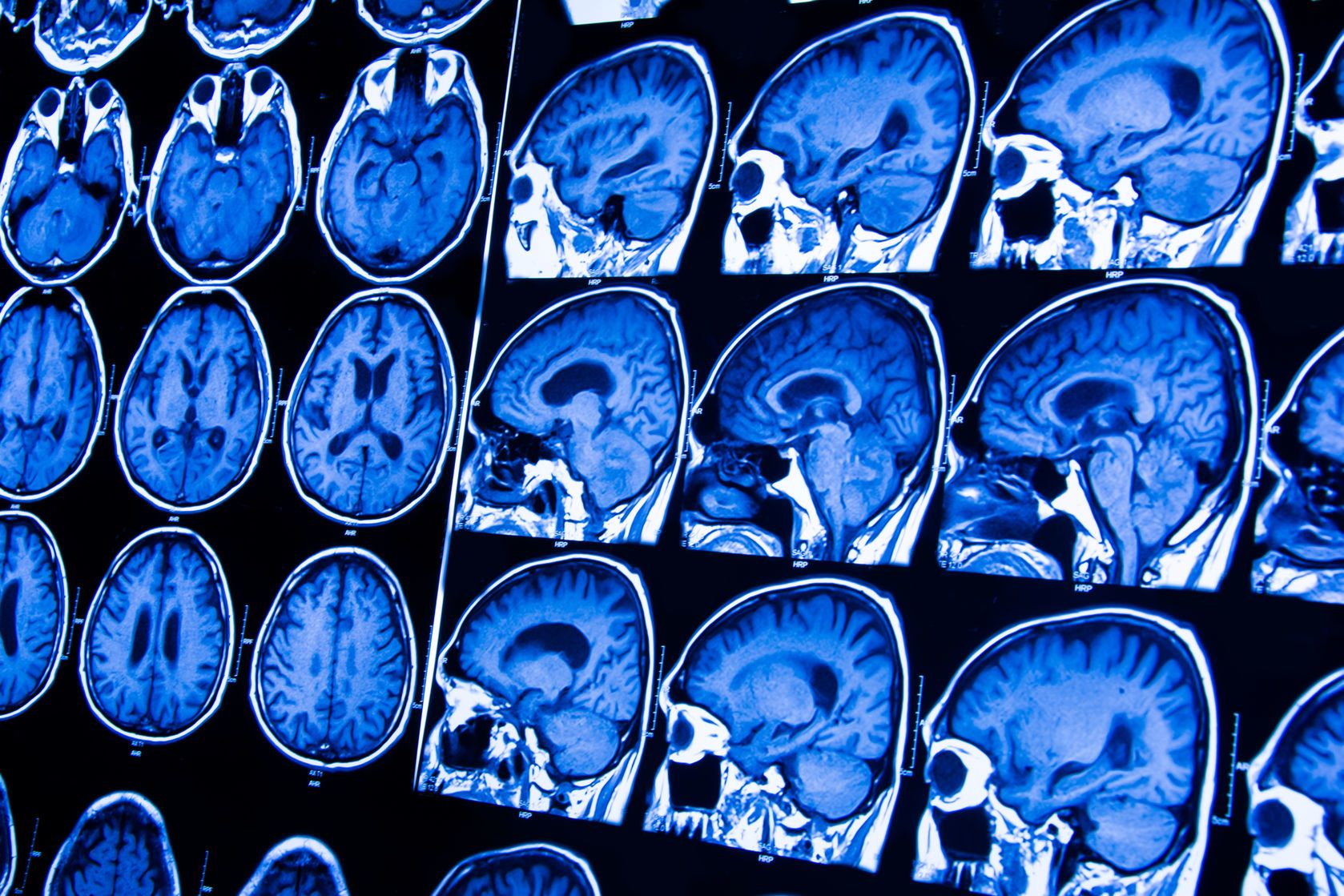 Wylew może powodować zaburzenia neurologiczne