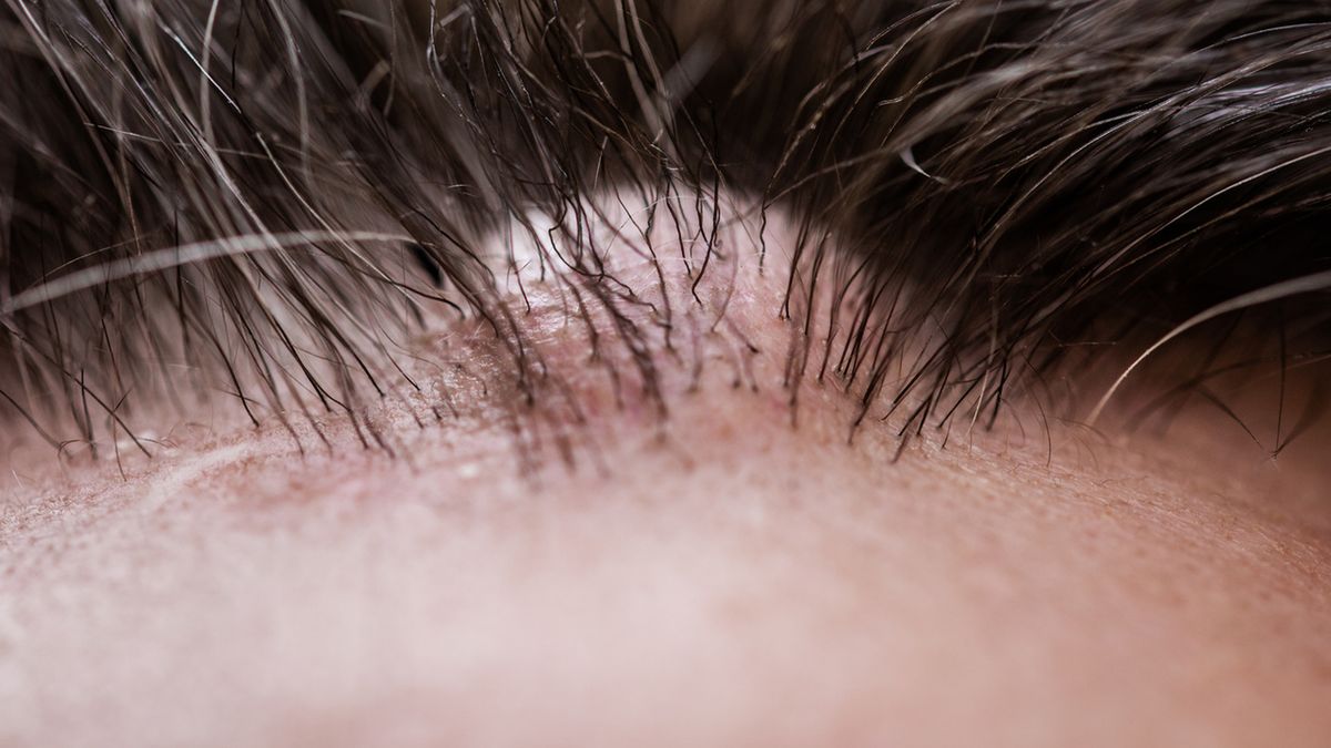 Kaszak na głowie to guzek tworzący się wskutek nagromadzenia łoju.