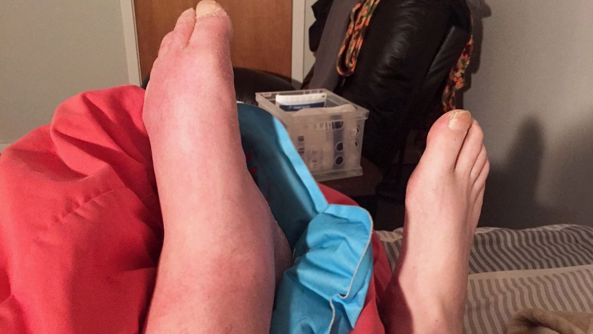 Upał zwiększa ryzyko wystąpienia zakrzepicy