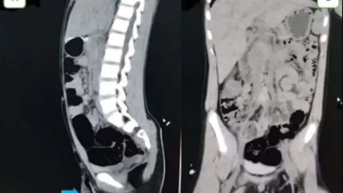 5-centymetrowy patyk (pokazany niebieską strzałką) wbity w mosznę chłopca. 