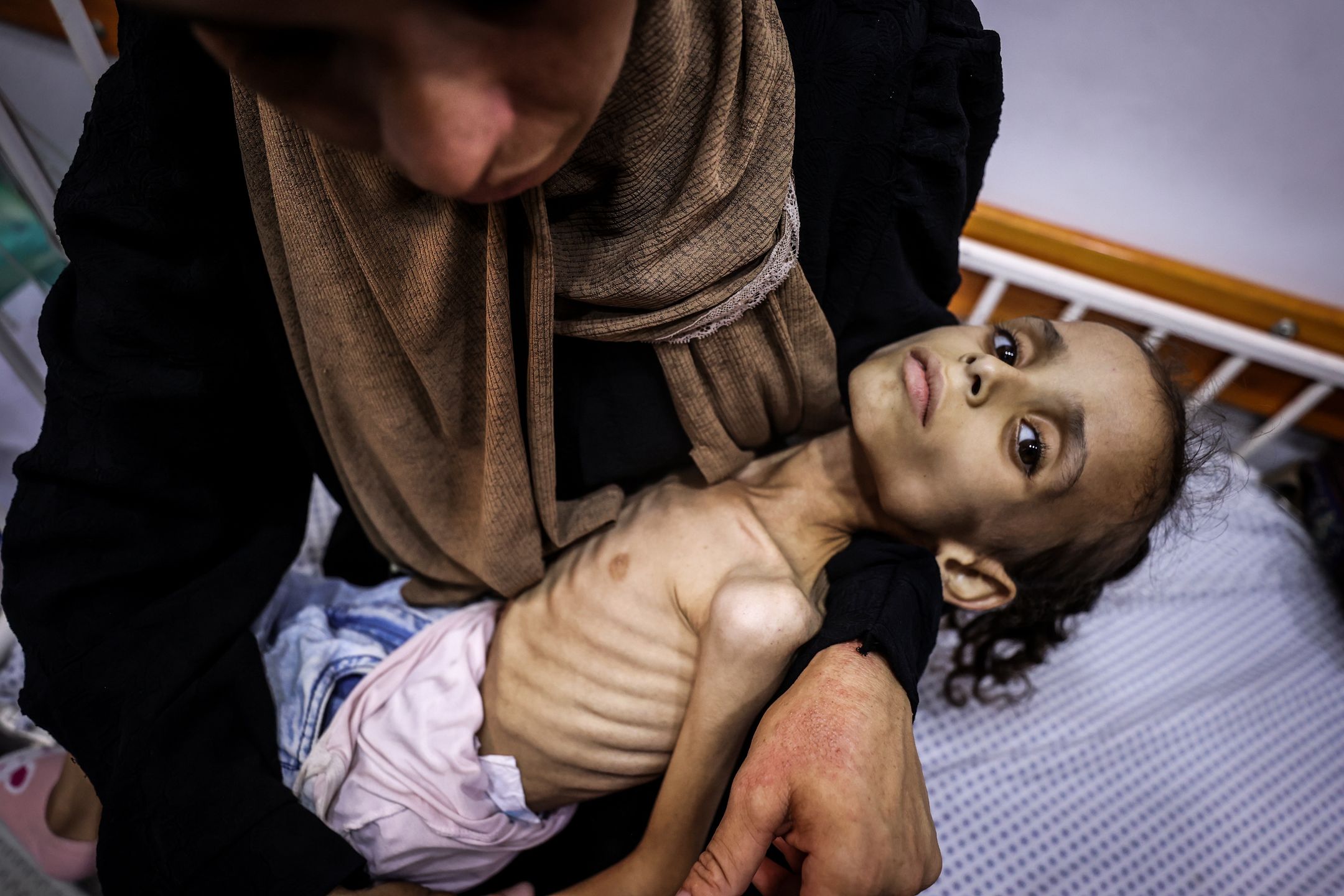 9-year-old Gaza child experiences life-threatening malnutrition
GAZA CITY, GAZA - AUGUST 03: 9-year-old Maryam Duvvas, receiving treatment at Patient Friends Association Hospital is reported to be in critical condition due to severe malnutrition in Gaza City, Gaza on August 03, 2025. Israel's closure of border crossings and its blockade are preventing the entry of food and medicine, pushing children in Gaza toward a deadly hunger crisis. (Photo by Ali Jadallah/Anadolu via Getty Images)
Anadolu
blockade, visible ribs, ribs, palestinian mother, starvation, food crisis, food blockade, palestinian baby, starving, gaza, gazan baby, israeli blockade, gazan mother, malnourished