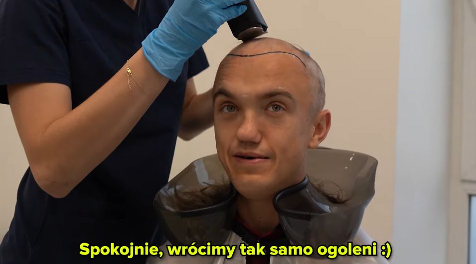 Mini Majk przeszczepił sobie włosy