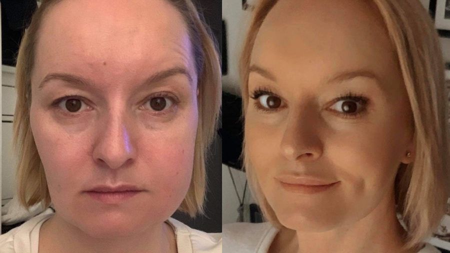 Agnieszka Kałuża zmagała się z poważnymi powikłaniami po wyrwaniu zęba mądrości 