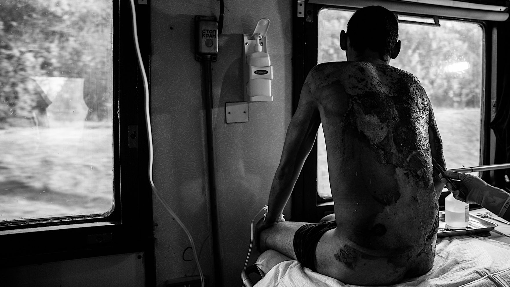 Mężczyzna z rozległym poparzeniem pleców na pokładzie pociągu medycznego "Lekarzy Bez Granic"
