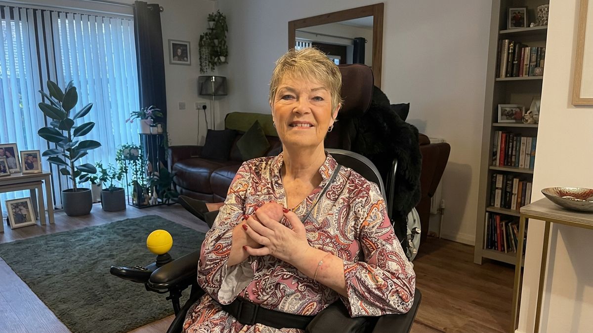 Kim przeszła sepsę, amputację kończyn i transplantację dłoni