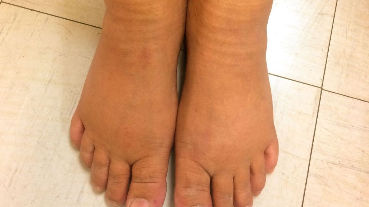 Objawem niedoboru witaminy B12 może być ból nóg