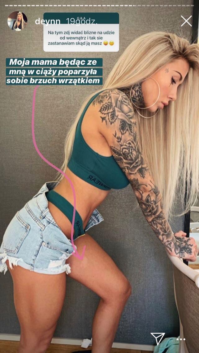 Deynn wyjaśnia pochodzenie blizny za pomocą ciążowych przesądów