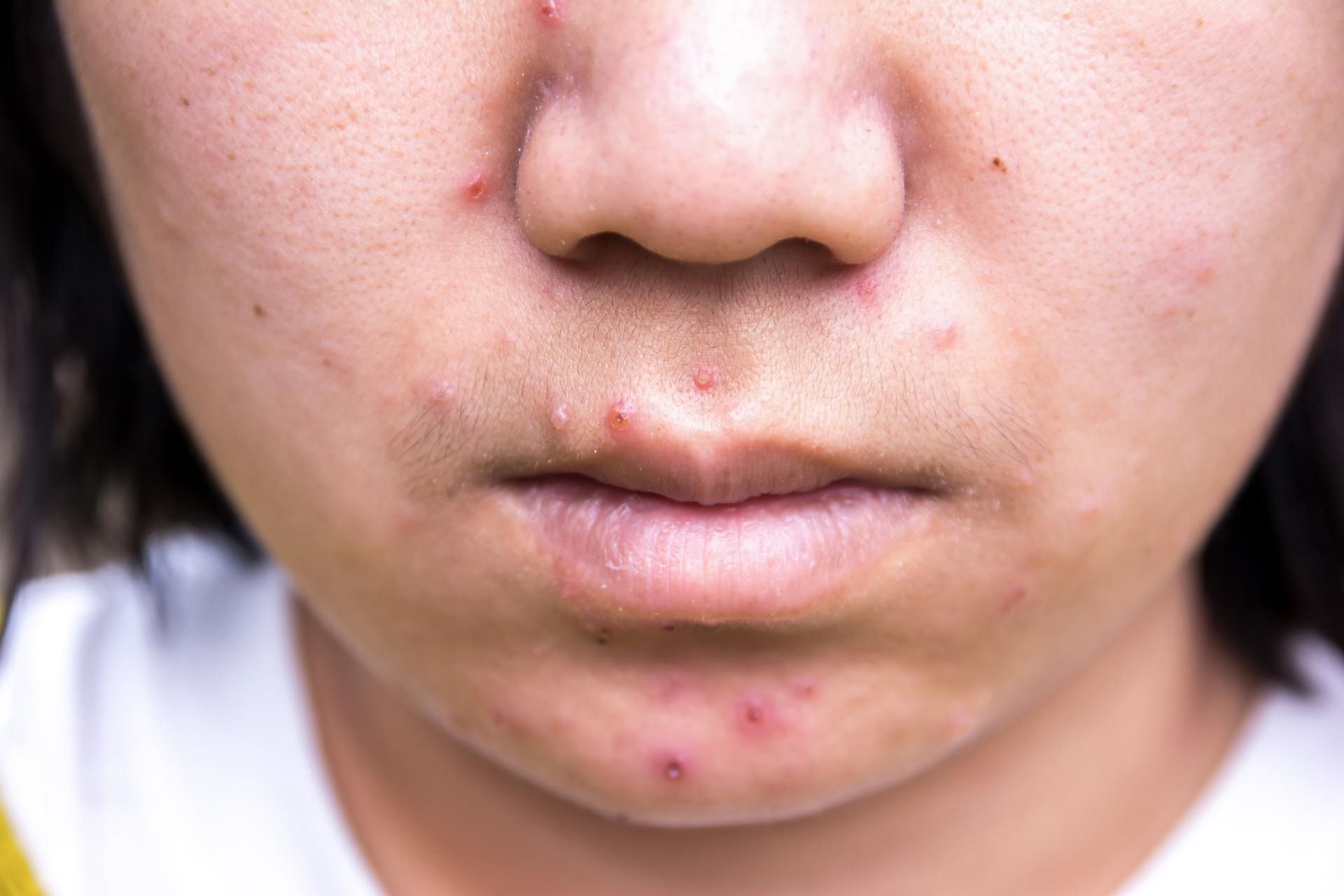 Uczulenie na twarzy może wystąpić w różnej formie dla przykładu drobnych krostek.
