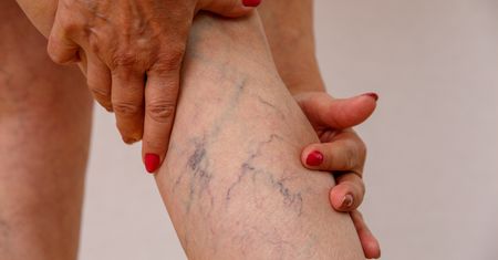 Cenna witamina. Regeneruje i wzmacnia żyły, chroni przed zakrzepicą