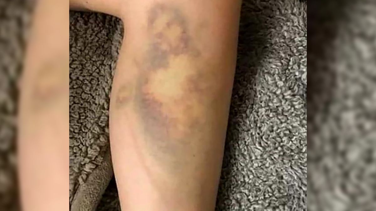 Świetny przykład pareidolii. W siniaku można się dopatrzeć wizerunku Jezusa Chrystusa - widać brodę oraz charakterystycznie rozłożone ręce i szatę.