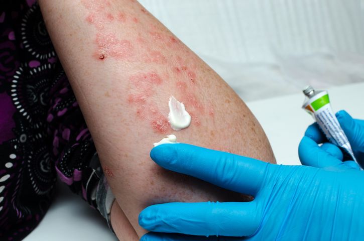 Nanobiotic Gold Skin Repair przeznaczony jest do leczenia skóry ze stanami zapalnymi