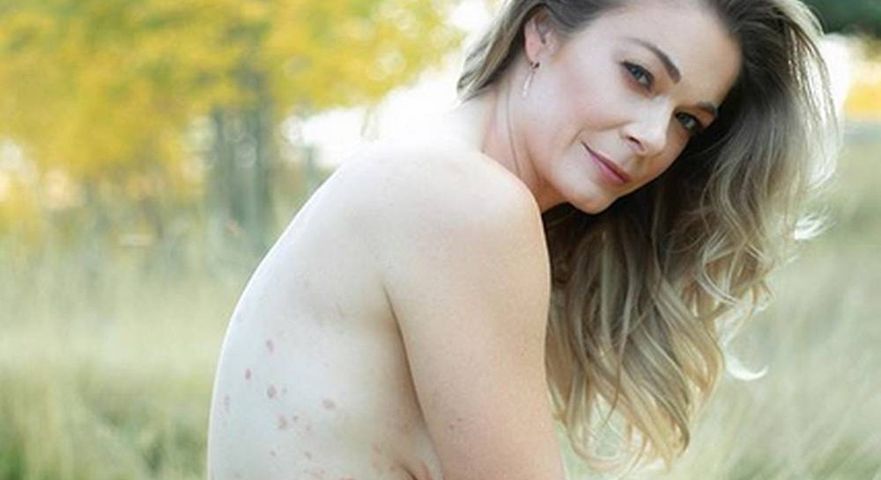 LeAnn Rimes wyznała, że choruje na łuszczycę