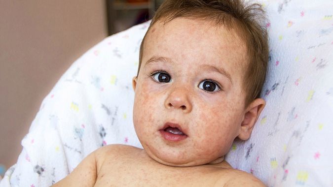 Atopowe zapalenie skóry u niemowlaka