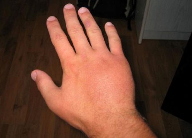 Spuchnięte dłonie to nie tylko defekt kosmetyczny czy przypadłość, która wywołuje dyskomfort. Można to również traktować jako sygnał, że w organizmie dzieje się coś niepokojącego.
