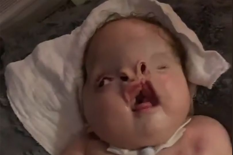 Chłopczyk żyje z ciężką wadą wrodzoną