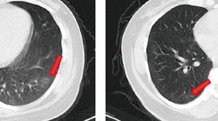 Nie mieli żadnych objawów koronawirusa. Mimo to mają uszkodzone płuca
