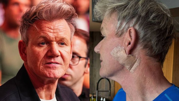 Gordon Ramsay walczy z rakiem skóry