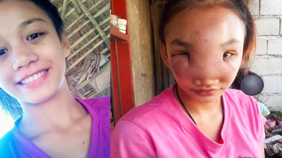 Wycisnęła krostę i spuchła. Tajemnicza choroba 