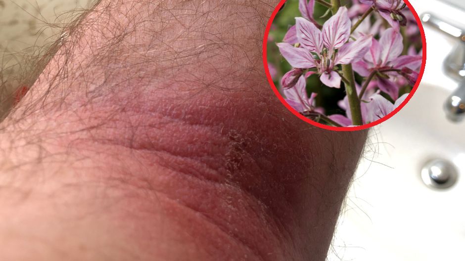 Uwaga na leki i kosmetyki na bazie fototoksycznych roślin. Mogą doprowadzić do silnej reakcji alergicznej, jeżeli wystawisz skórę na słońce