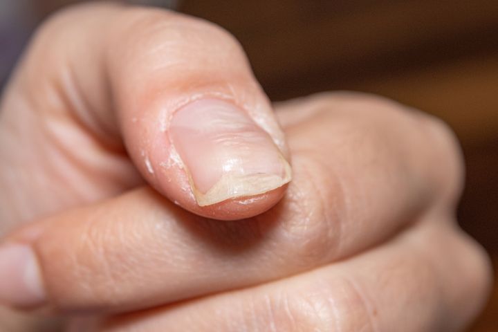 Bruzdy na paznokciach stanowią niewielki defekt kosmetyczny