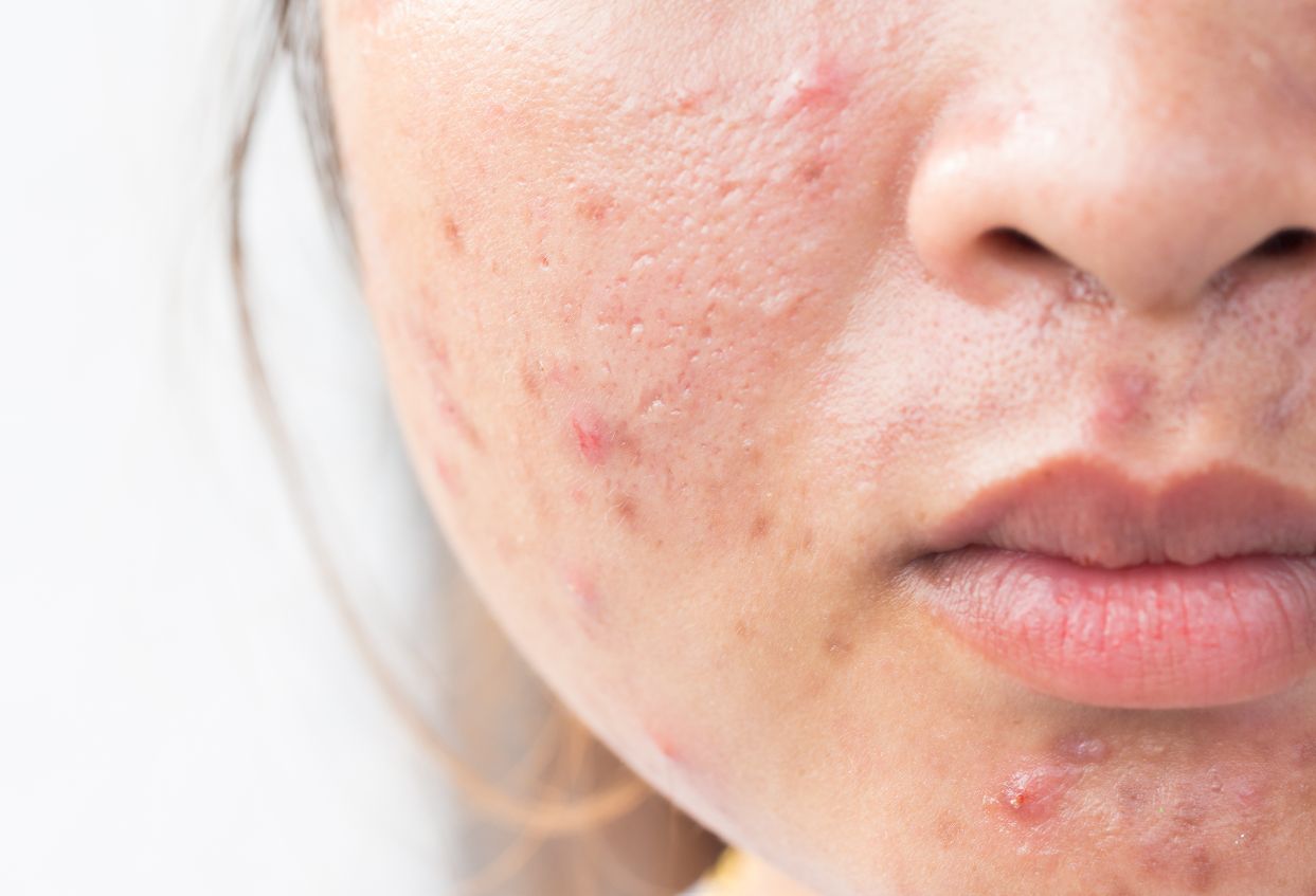 Kwas salicylowy na trądzik - jak działa, wskazania, skutki uboczne