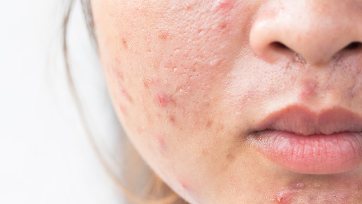 Kwas salicylowy na trądzik działa niezwykle skutecznie. Cechuje się działaniem przeciwzapalnym, redukuje zaskórniki i zmniejsza łojotok.