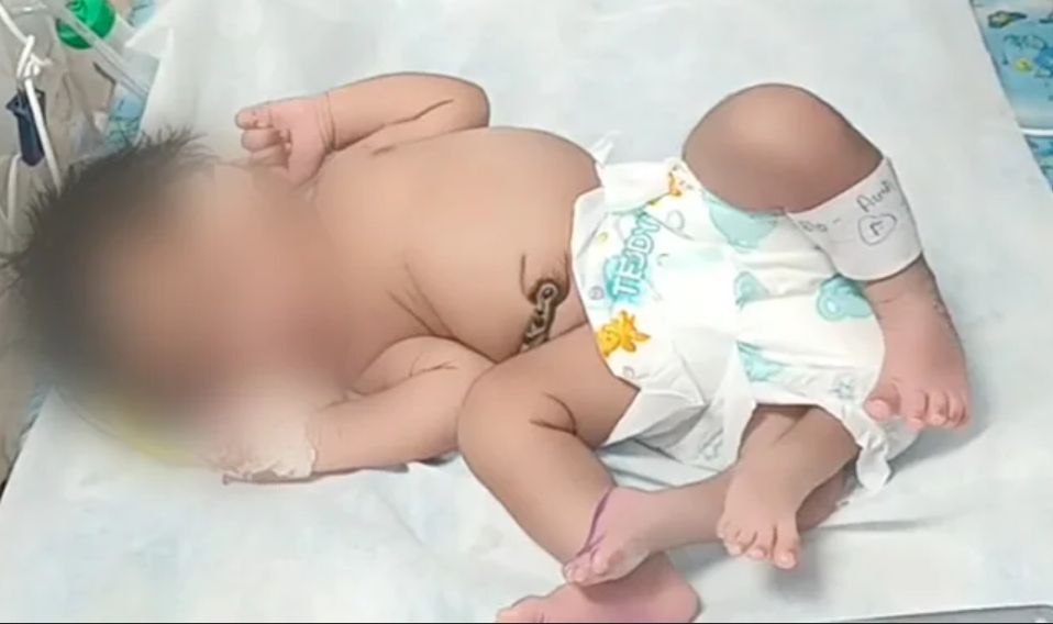 Dziewczynka urodziła się z czterema nogami