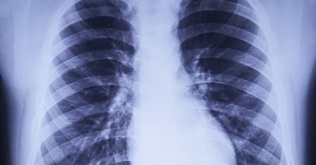 Koronawirus niewidoczny na zdjęciu RTG? Naukowcy: niektórzy zarażeni mają "czyste" płuca
