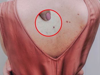 Na twoim ciele pojawiły się "rubinki"? To może być sygnał alarmowy