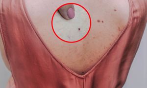 Na twoim ciele pojawiły się "rubinki"? To może być sygnał alarmowy