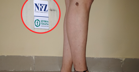 Tak rozpoznasz czerniaka. Liczba diagnoz wzrosła o 300 proc.