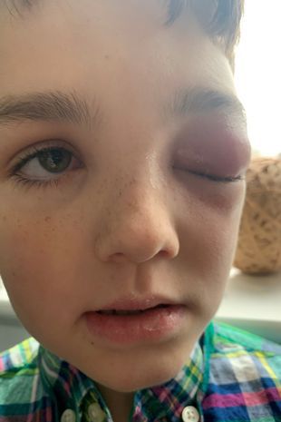 Oko Zaca zaczęło puchnąć