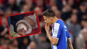 "Skaskował" go Bednarek. Tak wygląda noga piłkarza Nottingham