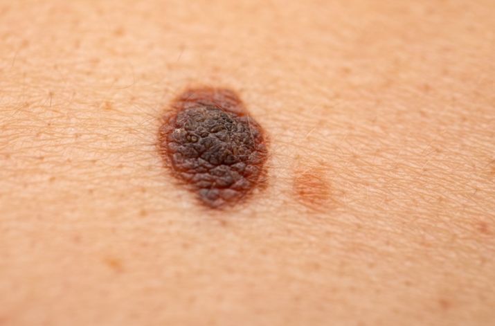Pieprzyki można usuwać za pomocą chirurgii, laseroterapii bądź krioterapii.