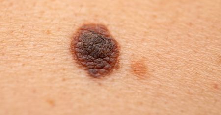 Usuwanie pieprzyków za pomocą tradycyjnych i innowacyjnych metod. Chirurgia, krioterapia, laseroterapia, elektrokoagulacja