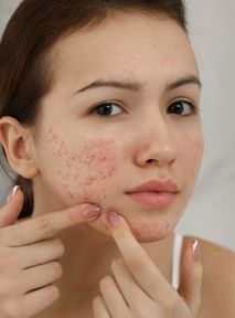 Acne, a problem that affects young people. What causes it and what treatments exist