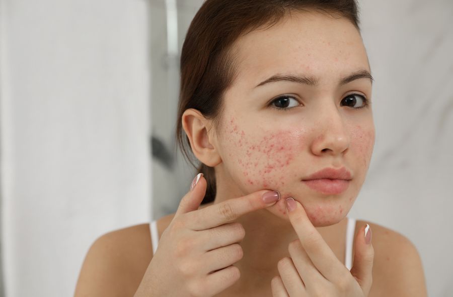 Acne, a problem that affects young people.